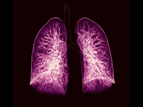 Trí tuệ nhân tạo giúp chẩn đoán ung thư phổi sớm một năm