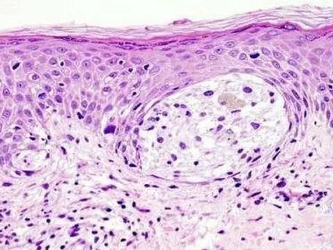 Thuốc điều trị ung thư tuyến tiền liệt hứa hẹn điều trị u hắc tố ở nam giới