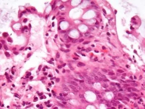 Trầm cảm và lo lắng ở bệnh nhân IBD có thể liên quan đến hàng rào mạch máu trong việc đóng đám rối màng mạch