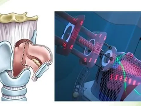 Ứng dụng phẫu thuật laser vi phẫu qua đường miệng trong điều trị ung thư thanh quản